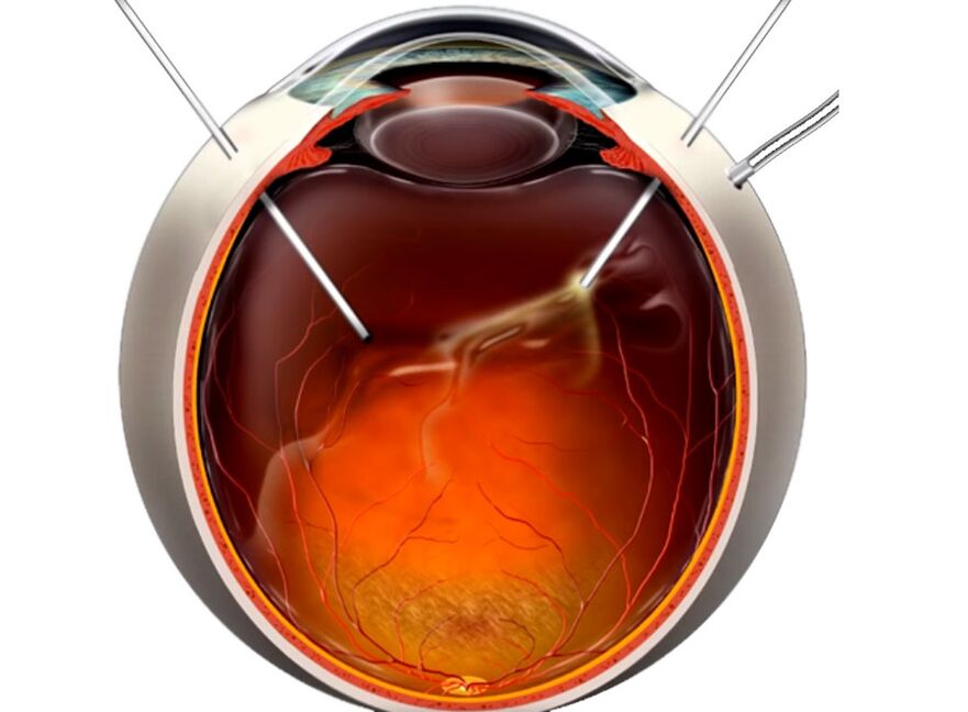 Vitrectomía un procedimiento que se muestra a las personas cuando la exfoliación de la retina